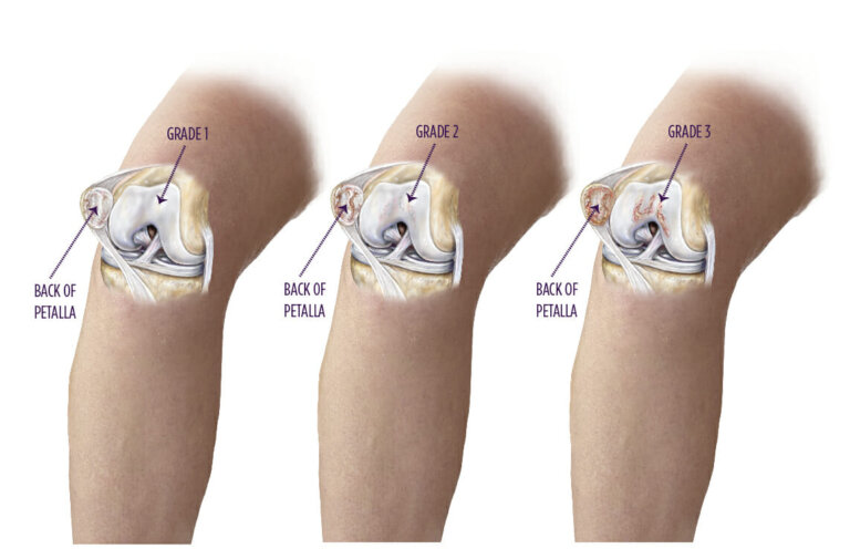 Chondromalacia Summit Orthopedics