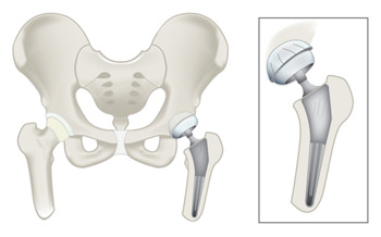 Total Hip Replacement - Summit OrthopedicsSummit Orthopedics