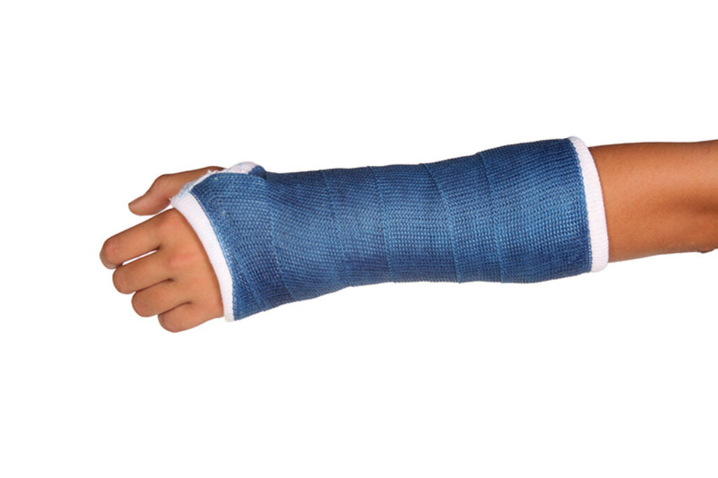 short arm cast  Arm cast, Broken arm cast, Broken hand cast