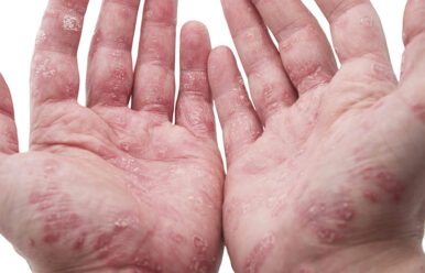 The Link Between Psoriasis And Arthritis | Summit Orthopedics