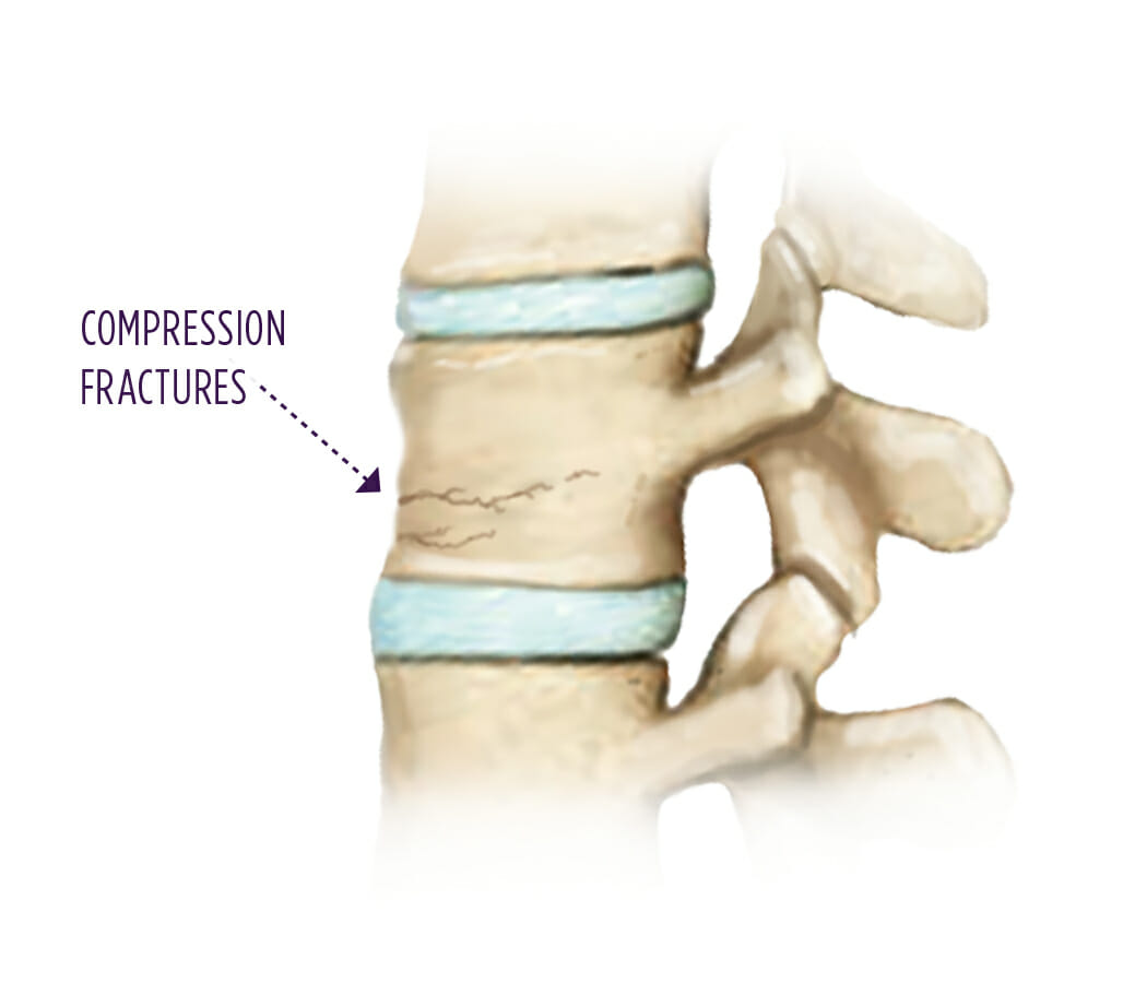 Vertebral Compression Fractures – Causes & Symptoms