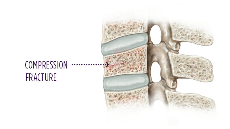 Vertebral Compression Fracture Summit Orthopedics | My XXX Hot Girl