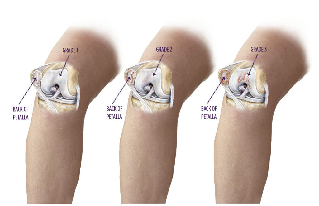 chondromalacia-summit-orthopedics