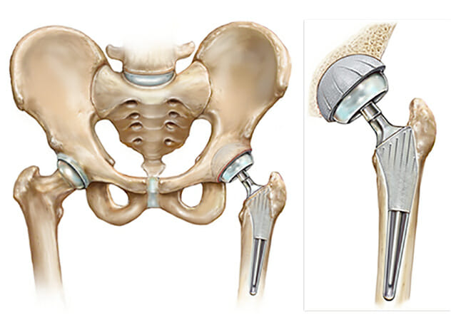 What is a Total Hip Replacement? - Cary Orthopaedics