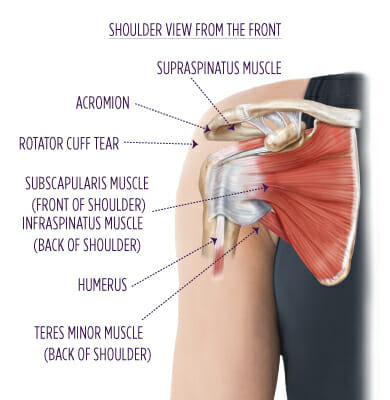 7 Shoulder ideas  shoulder replacement surgery, rotator cuff